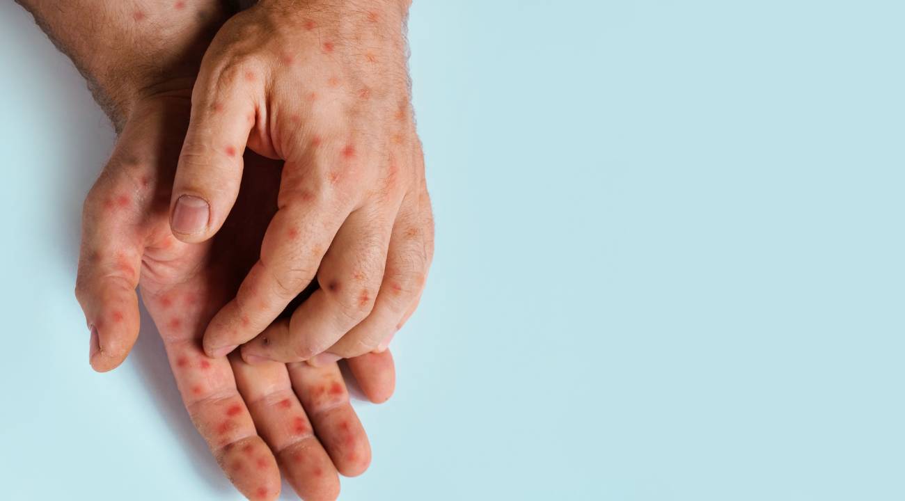 DSÖ'nün acil durum ilan ettiği maymun çiçeği (M çiçeği) hastalığı nasıl bulaşır, belirtileri neler? 